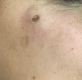 20250408 D22.3 Меланоформный невус других и неуточненных частей лица после