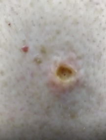 250114 D22.5 Меланоформный невус туловища после