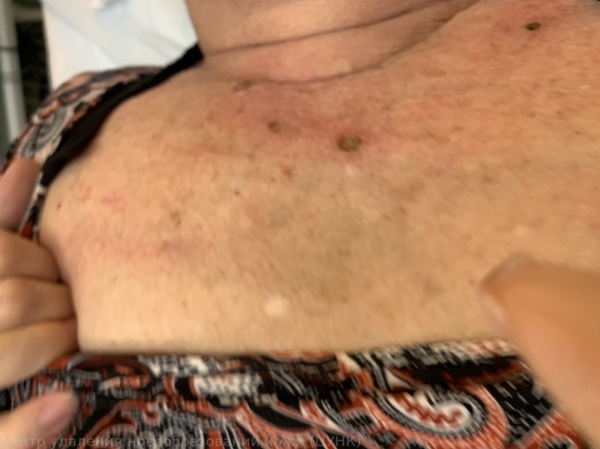 250114 L82 Себорейный кератоз после