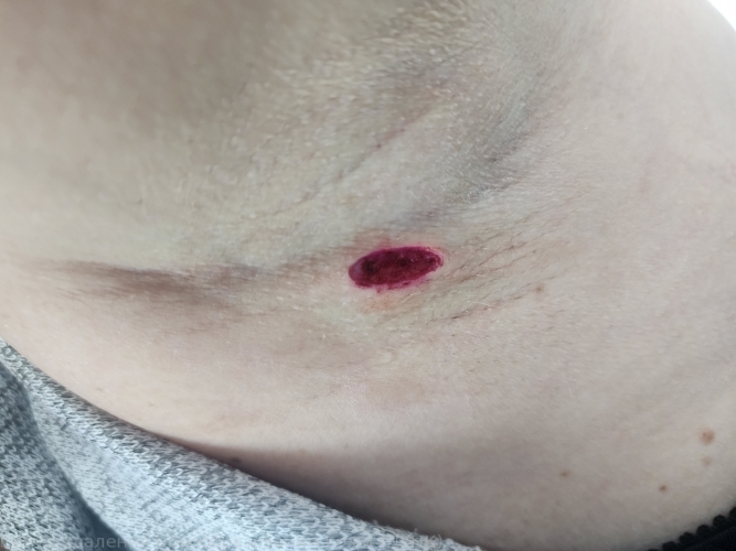 250118 D22.5 Меланоформный невус туловища после