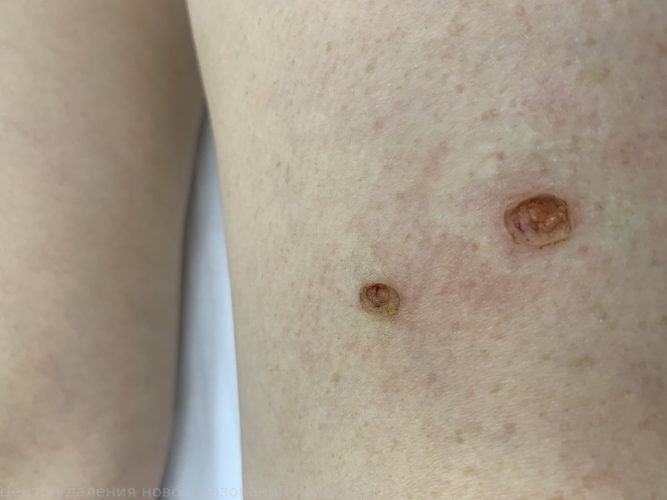 250125 L82 Себорейный кератоз после