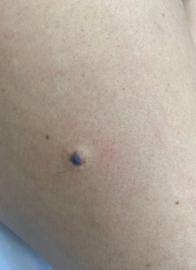 D22.7 Меланоформный невус нижней конечности, включая тазобедренную область