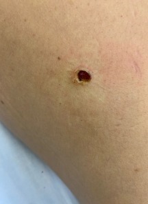 D22.7 Меланоформный невус нижней конечности, включая тазобедренную область 1