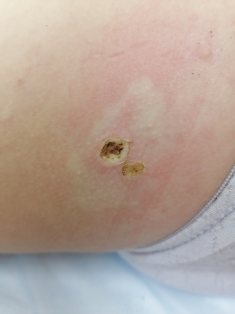 241222 D22.5 Меланоформный невус туловища после