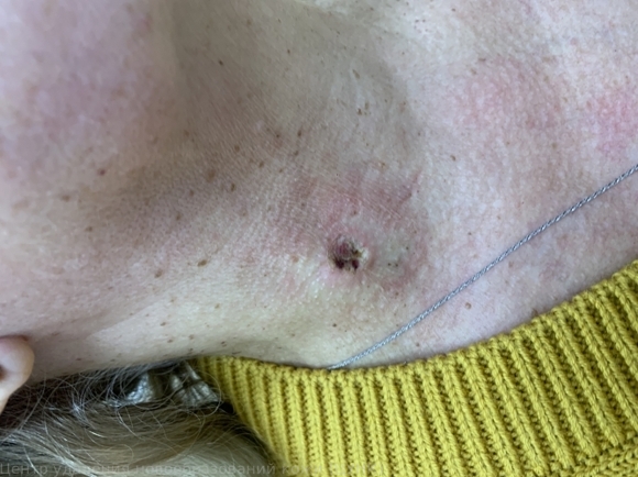 241107 L82 Себорейный кератоз после