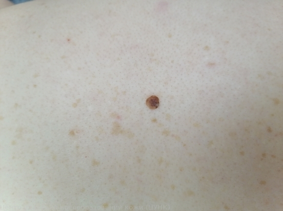 20250326 D22.5 Меланоформный невус туловища - до