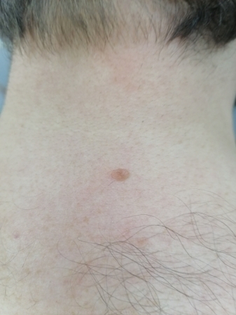 D22.4 Меланоформный невус волосистой части головы и шеи - удаление родинки лазером в Кемерове