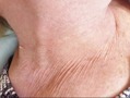 L82 Себорейный кератоз - удаление новообразования лазером в Кемерове