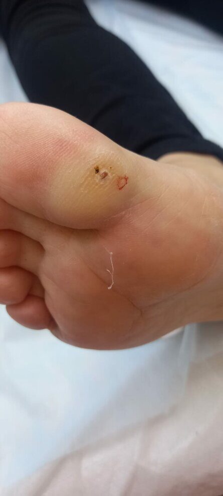 Удаление образований жидким азотом