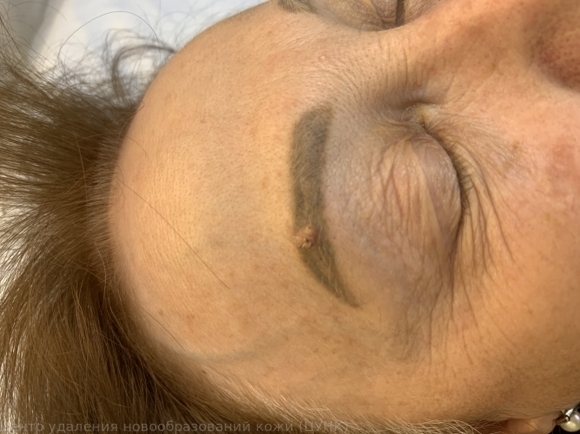 B07 Вирусные бородавки