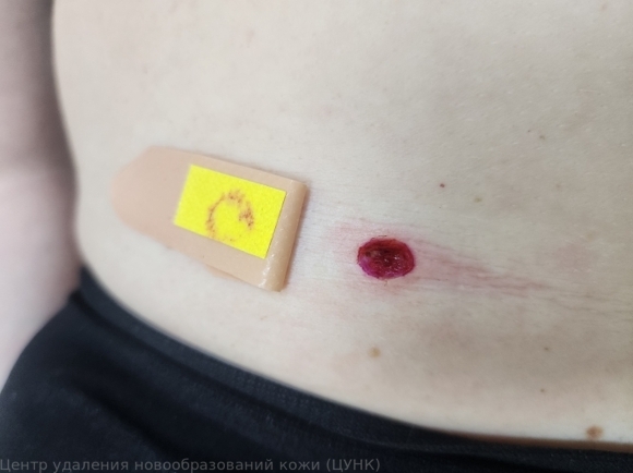 D22.5 Меланоформный невус туловища после