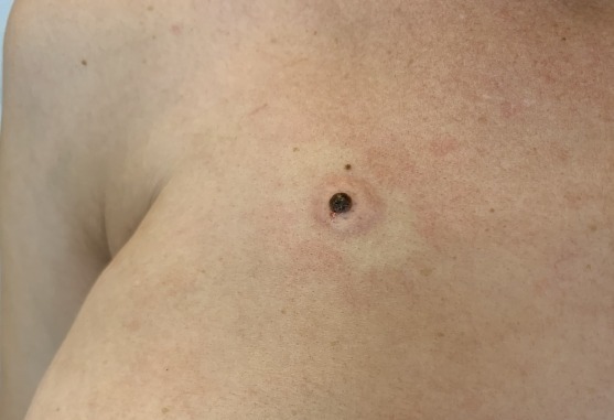 241209 L82 Себорейный кератоз до