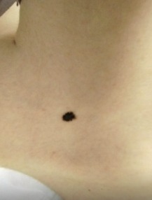 20250217-1 D22.5 Меланоформный невус туловища до