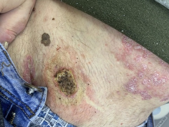 L82 Себорейный кератоз 1