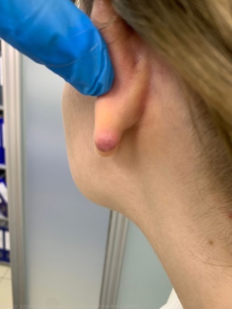 20240726 Келоид