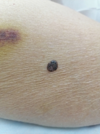 L82 Себорейный кератоз2