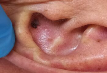 Ушная раковина