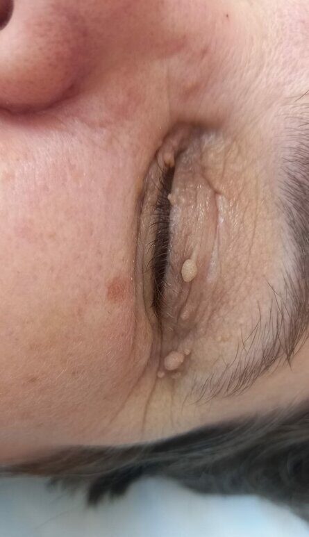 Какие бывают виды новообразований кожи