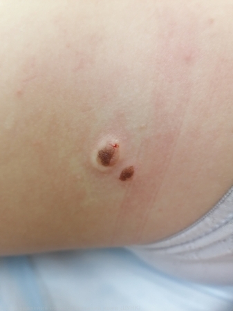 241222 D22.5 Меланоформный невус туловища до