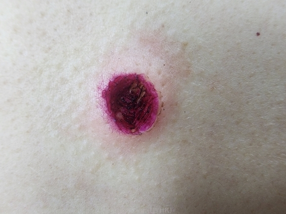 20241018 - D22.5 Меланоформный невус туловища1