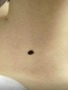 D22.5 Меланоформный невус туловища - удаление родинки на теле лазером в Кемерове