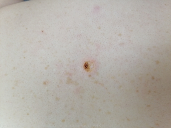 20250326 D22.5 Меланоформный невус туловища - после