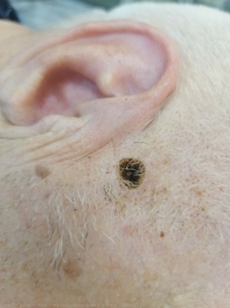 20250303 L98.6 Другие инфильтративные болезни кожи и подкожной клетчатки после