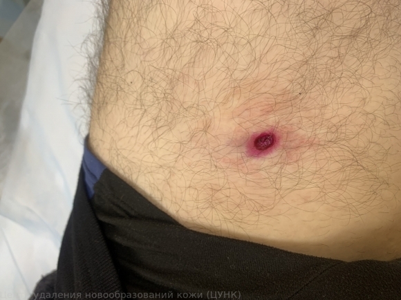 241123 L98.0 Пиогенная гранулема после