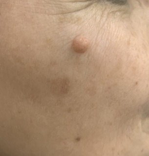 20250408 D22.3 Меланоформный невус других и неуточненных частей лица до