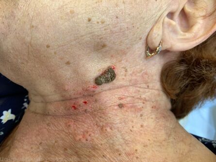 НОВАЯ РУБРИКА! Атлас кожи, или гистологически подтвержденные новообразования кожи