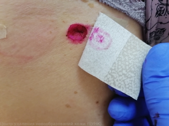 20250313 L82 Себорейный кератоз после