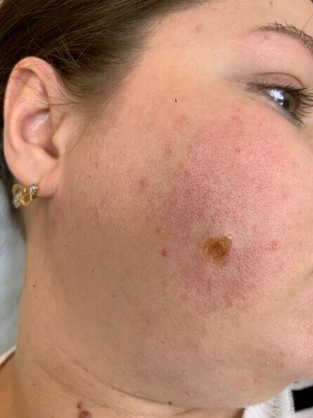 Как происходит удаление новообразования