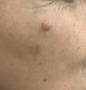 D22.3 Меланоформный невус других и неуточненных частей лица - удаление родинки на лице лазером в Кемерове