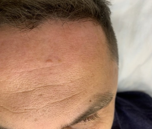 241110 L82 Себорейный кератоз до