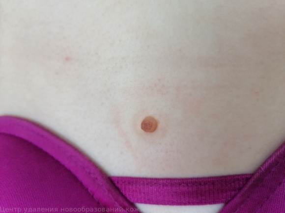 241217 D22.5 Меланоформный невус туловища 