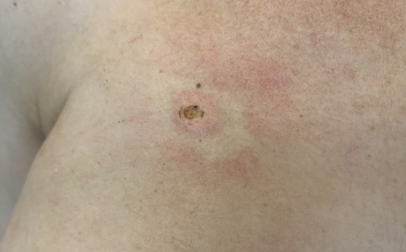 241209 L82 Себорейный кератоз после