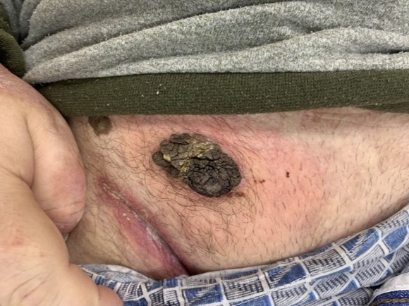 L82 Себорейный кератоз