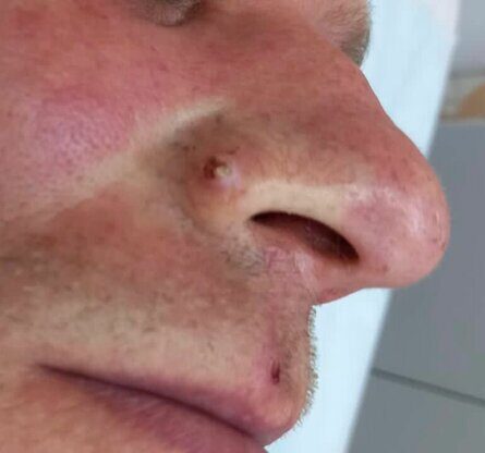 Надо ли удалять доброкачественное образование кожи