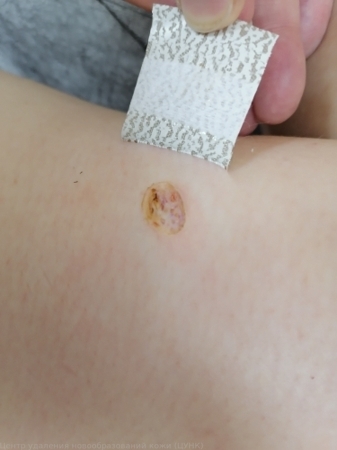 20250221 D18.0 Гемангиома любой локализации после