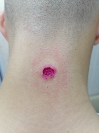 291024 D22.4 Меланоформный невус волосистой части головы и шеи