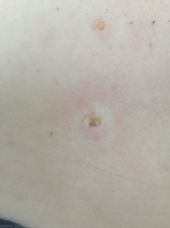 241130 D22.5 Меланоформный невус туловища после