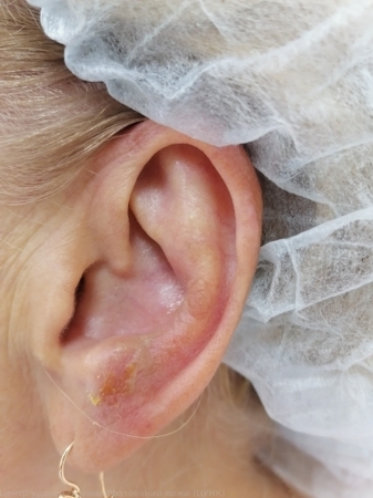 20241020 L82 Себорейный кератоз ухо