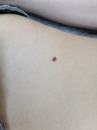 20250226 D22.5 Меланоформный невус туловища 2