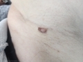 D22.5 Меланоформный невус туловища -  удаление родинки лазером на теле в Кемерове