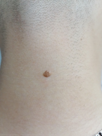 241029 D22.4 Меланоформный невус волосистой части головы и шеи1