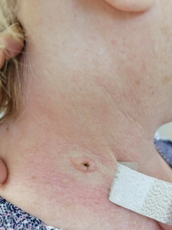 241210 L82 Себорейный кератоз после