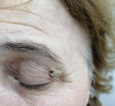 241025 B07 Вирусные бородавки22