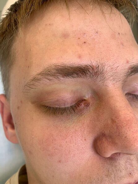 Какой способ удаления папиллом самый эффективный