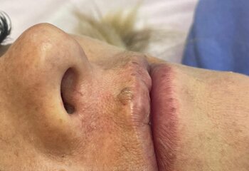 Удаление на губе