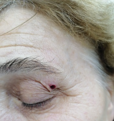 241025 B07 Вирусные бородавки 11